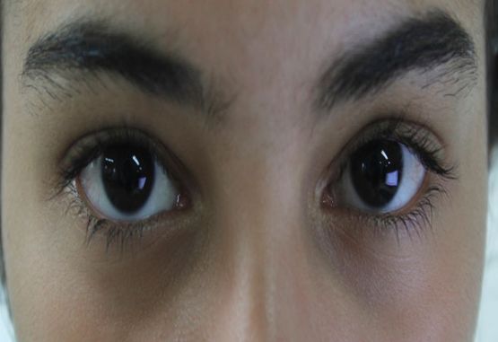 Glaucoma
